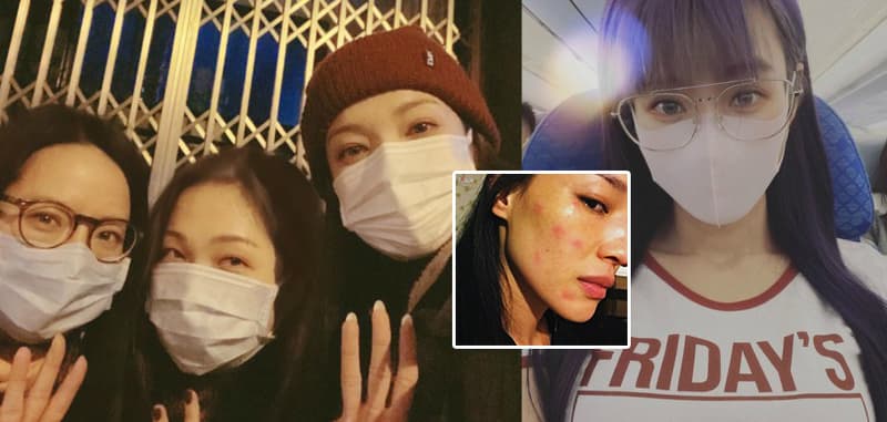 日日戴口罩狂爆暗瘡出紅疹！5大重點對付戴口罩後遺症