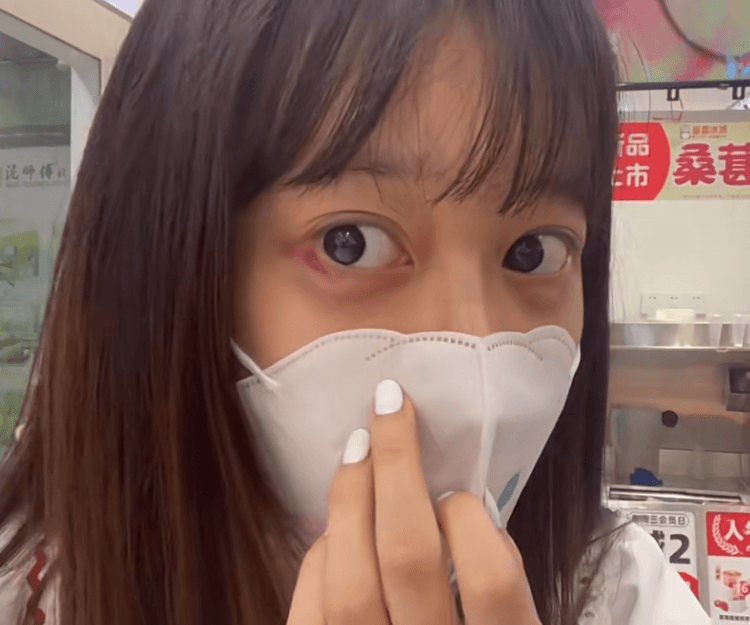 大陸女生不合規格醫美療程失敗 透明質酸臥蠶慘變「大眼袋」