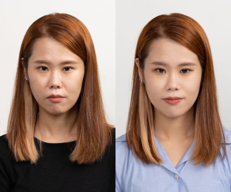 醫學美容｜輕熟女必看！Sculptra® 膠原逆齡再生的秘密