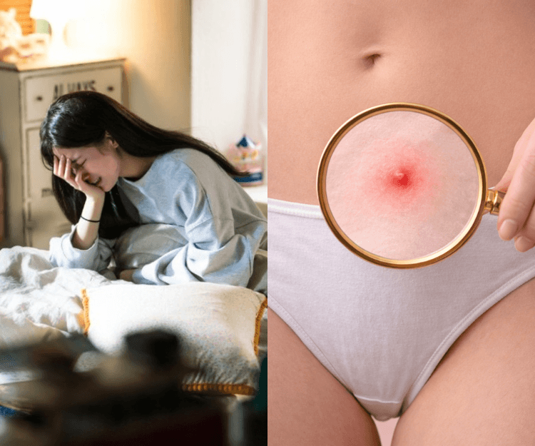 私密處生粒粒心慌慌？了解5大陰部暗瘡的成因及症狀 用手擠是大忌！